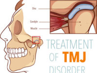tmj disorders