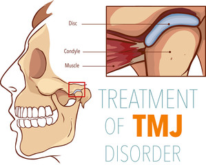 Symptoms Of TMJ Disorders